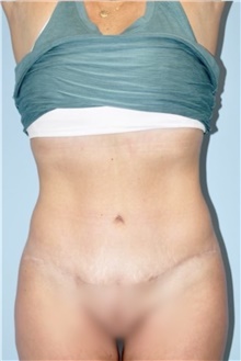 Liposuction After Photo by Keyian Paydar, MD, FACS; Newport Beach, CA - Case 47140