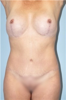 Liposuction Before Photo by Keyian Paydar, MD, FACS; Newport Beach, CA - Case 47140