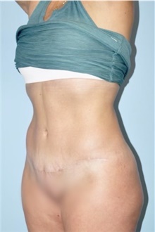 Liposuction After Photo by Keyian Paydar, MD, FACS; Newport Beach, CA - Case 47140