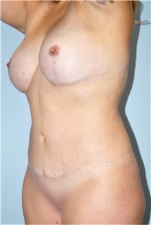 Liposuction Before Photo by Keyian Paydar, MD, FACS; Newport Beach, CA - Case 47140