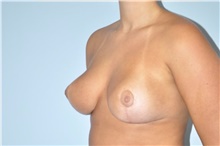 Breast Reduction After Photo by Keyian Paydar, MD, FACS; Newport Beach, CA - Case 47645