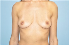 Breast Implant Removal After Photo by Keyian Paydar, MD, FACS; Newport Beach, CA - Case 47688