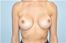 Breast Implant Removal Before Photo by Keyian Paydar, MD, FACS; Newport Beach, CA - Case 47688