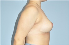 Breast Reduction After Photo by Keyian Paydar, MD, FACS; Newport Beach, CA - Case 47824