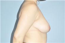 Breast Reduction Before Photo by Keyian Paydar, MD, FACS; Newport Beach, CA - Case 47824