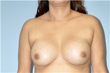 Breast Implant Revision Before Photo by Keyian Paydar, MD, FACS; Newport Beach, CA - Case 47848