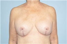 Breast Implant Revision After Photo by Keyian Paydar, MD, FACS; Newport Beach, CA - Case 48359