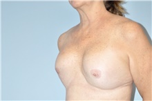 Breast Implant Revision Before Photo by Keyian Paydar, MD, FACS; Newport Beach, CA - Case 48359