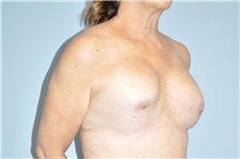 Breast Implant Revision Before Photo by Keyian Paydar, MD, FACS; Newport Beach, CA - Case 48359