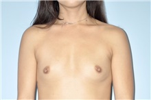 Breast Augmentation Before Photo by Keyian Paydar, MD, FACS; Newport Beach, CA - Case 48363