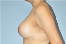 Breast Lift After Photo by Keyian Paydar, MD, FACS; Newport Beach, CA - Case 48399
