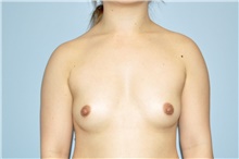 Breast Augmentation Before Photo by Keyian Paydar, MD, FACS; Newport Beach, CA - Case 48523
