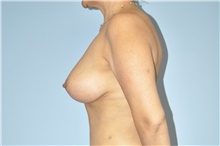 Breast Lift After Photo by Keyian Paydar, MD, FACS; Newport Beach, CA - Case 48524