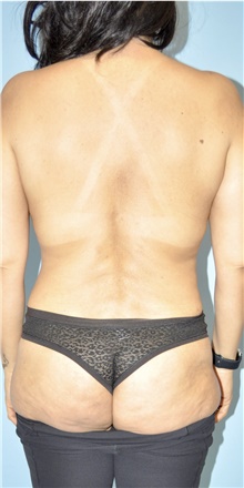 Liposuction After Photo by Keyian Paydar, MD, FACS; Newport Beach, CA - Case 48525