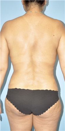 Liposuction Before Photo by Keyian Paydar, MD, FACS; Newport Beach, CA - Case 48525