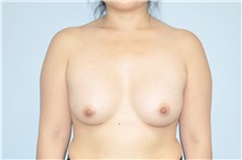 Breast Augmentation After Photo by Keyian Paydar, MD, FACS; Newport Beach, CA - Case 48558