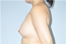 Breast Augmentation After Photo by Keyian Paydar, MD, FACS; Newport Beach, CA - Case 48558