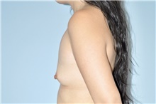 Breast Augmentation Before Photo by Keyian Paydar, MD, FACS; Newport Beach, CA - Case 48558