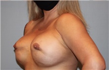 Breast Implant Revision Before Photo by Keyian Paydar, MD, FACS; Newport Beach, CA - Case 48603