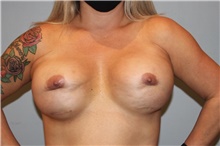 Breast Implant Revision Before Photo by Keyian Paydar, MD, FACS; Newport Beach, CA - Case 48603