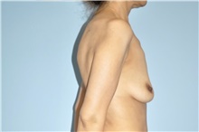 Breast Lift Before Photo by Keyian Paydar, MD, FACS; Newport Beach, CA - Case 49053