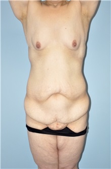 Body Lift Before Photo by Keyian Paydar, MD, FACS; Newport Beach, CA - Case 51119