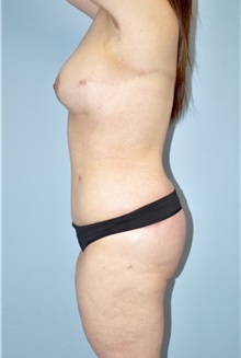 Body Lift After Photo by Keyian Paydar, MD, FACS; Newport Beach, CA - Case 51119