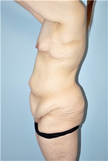 Body Lift Before Photo by Keyian Paydar, MD, FACS; Newport Beach, CA - Case 51119