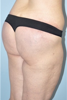 Body Lift After Photo by Keyian Paydar, MD, FACS; Newport Beach, CA - Case 51119