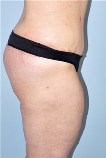 Body Lift After Photo by Keyian Paydar, MD, FACS; Newport Beach, CA - Case 51119