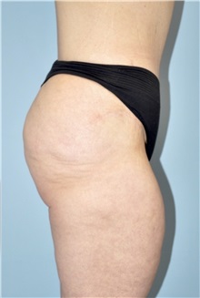 Body Lift Before Photo by Keyian Paydar, MD, FACS; Newport Beach, CA - Case 51119