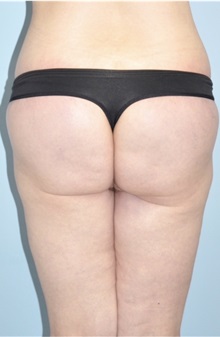 Buttock Lift with Augmentation After Photo by Keyian Paydar, MD, FACS; Newport Beach, CA - Case 51120