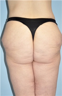 Buttock Lift with Augmentation Before Photo by Keyian Paydar, MD, FACS; Newport Beach, CA - Case 51120