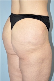 Buttock Lift with Augmentation Before Photo by Keyian Paydar, MD, FACS; Newport Beach, CA - Case 51120