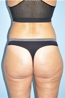 Buttock Lift with Augmentation After Photo by Keyian Paydar, MD, FACS; Newport Beach, CA - Case 51122