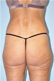 Buttock Lift with Augmentation Before Photo by Keyian Paydar, MD, FACS; Newport Beach, CA - Case 51122