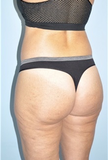 Buttock Lift with Augmentation After Photo by Keyian Paydar, MD, FACS; Newport Beach, CA - Case 51122