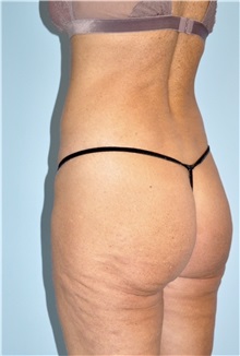 Buttock Lift with Augmentation Before Photo by Keyian Paydar, MD, FACS; Newport Beach, CA - Case 51122