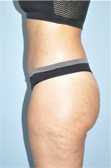 Buttock Lift with Augmentation After Photo by Keyian Paydar, MD, FACS; Newport Beach, CA - Case 51122