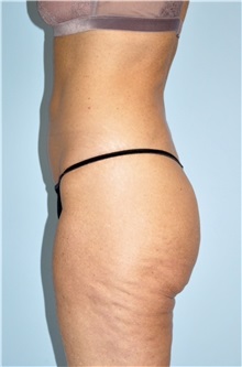 Buttock Lift with Augmentation Before Photo by Keyian Paydar, MD, FACS; Newport Beach, CA - Case 51122