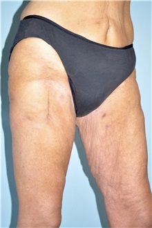 Thigh Lift Before Photo by Keyian Paydar, MD, FACS; Newport Beach, CA - Case 51127