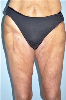 Thigh Lift Before Photo by Keyian Paydar, MD, FACS; Newport Beach, CA - Case 51127