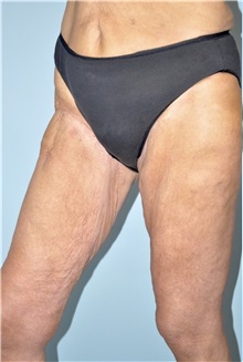 Thigh Lift Before Photo by Keyian Paydar, MD, FACS; Newport Beach, CA - Case 51127