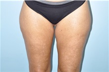 Thigh Lift After Photo by Keyian Paydar, MD, FACS; Newport Beach, CA - Case 51126