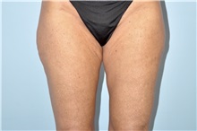 Thigh Lift Before Photo by Keyian Paydar, MD, FACS; Newport Beach, CA - Case 51126