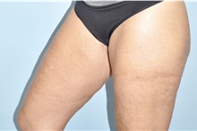 Thigh Lift After Photo by Keyian Paydar, MD, FACS; Newport Beach, CA - Case 51126