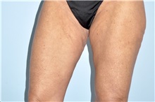 Thigh Lift Before Photo by Keyian Paydar, MD, FACS; Newport Beach, CA - Case 51126