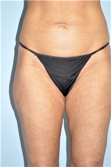 Thigh Lift Before Photo by Keyian Paydar, MD, FACS; Newport Beach, CA - Case 51126