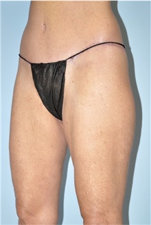 Thigh Lift After Photo by Keyian Paydar, MD, FACS; Newport Beach, CA - Case 51126