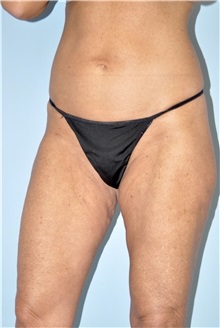 Thigh Lift Before Photo by Keyian Paydar, MD, FACS; Newport Beach, CA - Case 51126